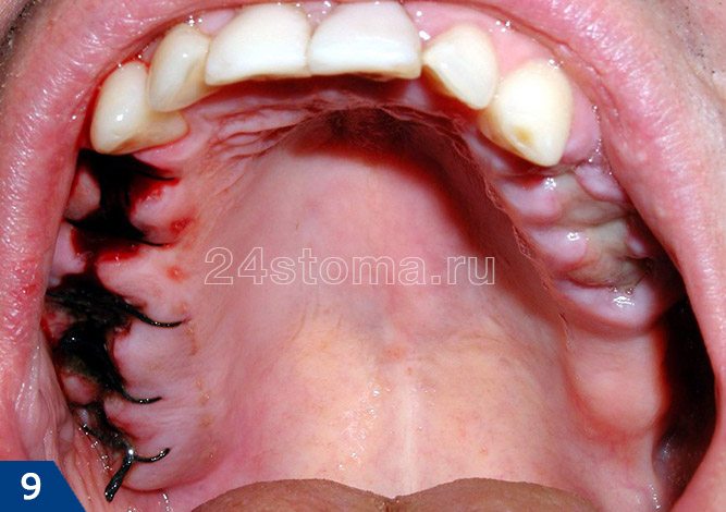Вид трех лунок удаленных зубов спустя 12 часов после удаления