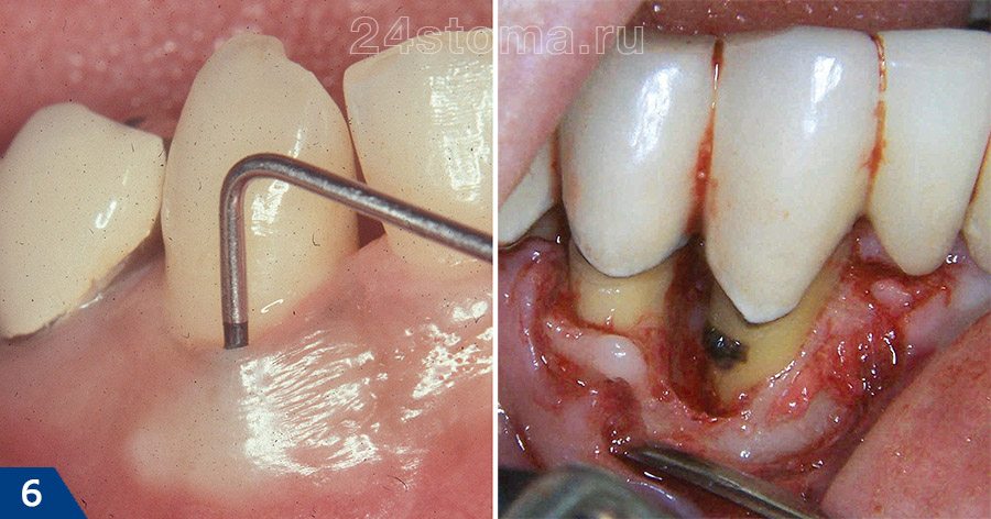 Вид пародонтального кармана с зубными отложениями (до и после отслойки десны)