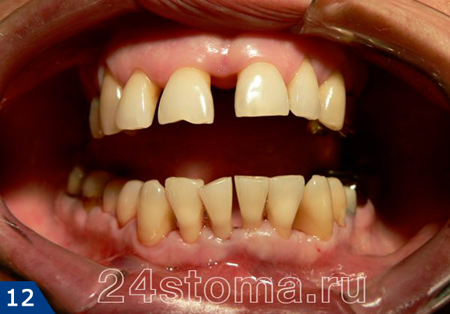 Пародонтит средней степени тяжести. Вид зубов и десен после снятия зубных отложений и проведения противовоспалительной терапии.