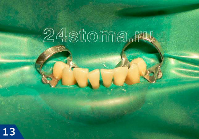 Процесс шинирования зубов: наложение коффердама для изоляции зубов от слюны.