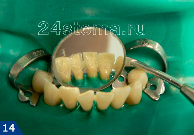 Процесс шинирования зубов: укладка стекло-волоконной ленты с внутренней поверхности зубов