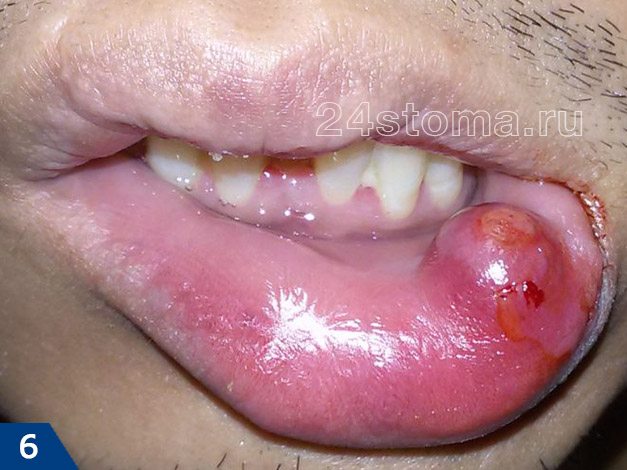 Ретенционная киста на губе