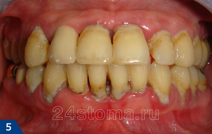 Пародонтит. Визуально определяются скопления мягкого зубного налета и твердого зубного камня, оголение корней зубов, воспаление краевой десны.