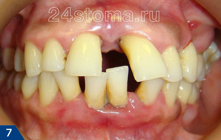 Пародонтит тяжелой степени. Выраженная атрофия кости, расхождение зубов, скопления твердых зубных отложений.