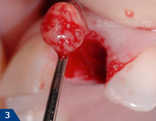 Вид гранулемы, выскобленной из лунки сразу после удаления зуба