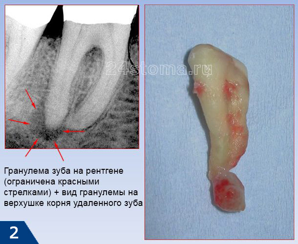 Гранулема зуба на рентгене (ограничена красными стрелками) + вид гранулемы на верхушке корня удаленного зуба