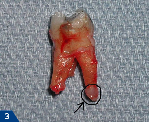Гранулема, прикрепленная к верхушке корня удаленного зуба