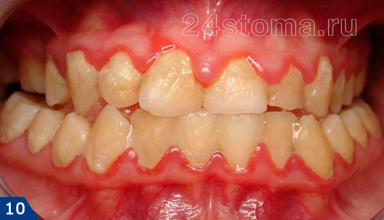 Гингивит: краевая десна воспалена, зубодесневые сосочки красные отечные, обилие микробного зубного налета у шеек зубов