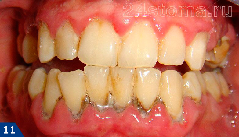 Пародонтит: обилие микробного налета и твердых зубных отложений, краевая десна красная, отечная, атрофия кости в области нижних зубов.