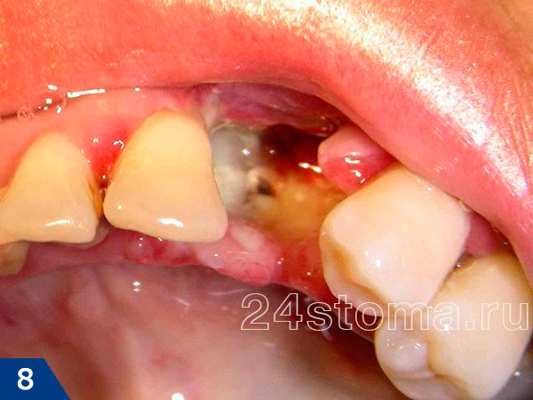 Воспаление лунки удаленного зуба (альвеолит): лунка пустая, в глубине следы некротического распада кровяного сгустка и обнаженной костной ткани альвеолы