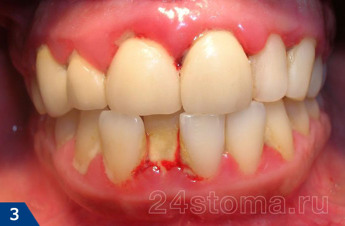 Гингивит. Визуально: краевая десна наиболее воспалена в местах скопления мягкого микробного налета и твердого зубного камня.