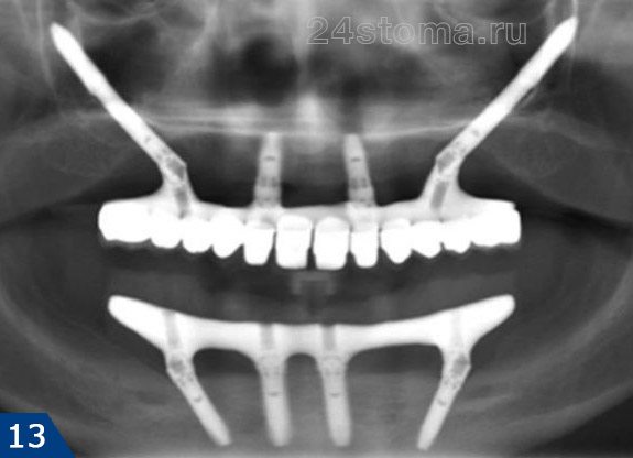 Рентгенограмма пациента с All-on-4, у которого на верхней челюсти были применены два скуловых импланта Nobel-Zygoma