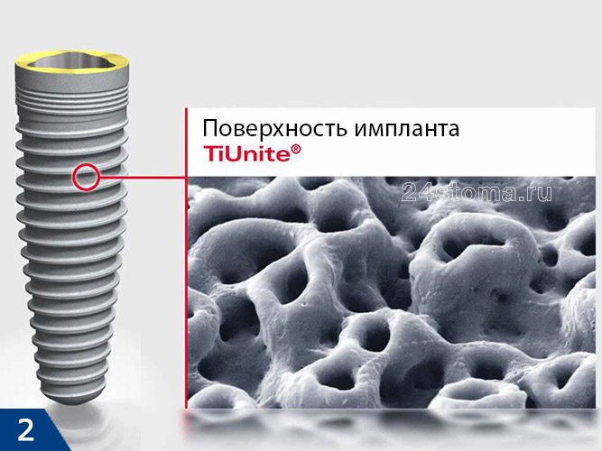 Поверхность имплантов Нобель - "TiUnite"