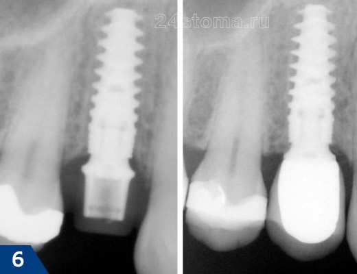 Рентгенограмма импланта Nobel-Active сразу после установки и спустя 6 месяцев (видно увеличение объема кости в области шейки импланта)