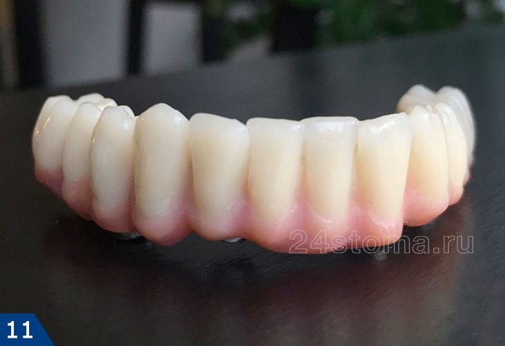 Несъемный зубной протез на 4 имплантах