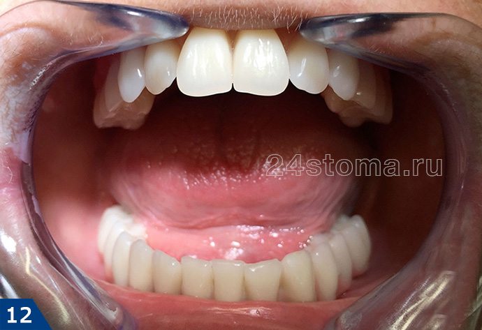 На нижней челюсти на 4 имплантах зафиксирован постоянный несъемный мостовидный протез (для верхней челюсти изготовлен обычный съемный зубной протез)