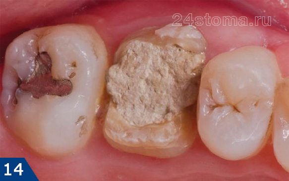 Зуб под пломбой подлежит удалению