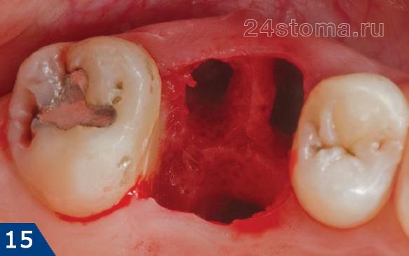 Вид лунки удаленного зуба