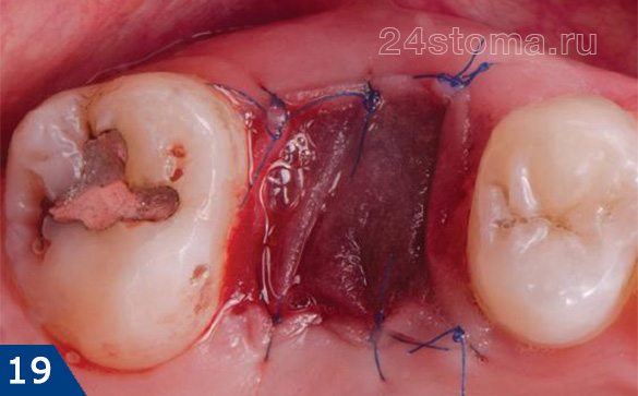 Раневая поверхность прикрыта наглухо биорезорбируемой мембраной (с целью направленной регенерации костной ткани в лунке удаленного зуба)