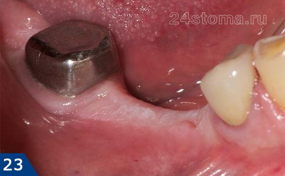 Исходная ситуация: отсутствуют 5-6 зубы на нижней челюсти (4-й зуб под металлокерамической коронкой)