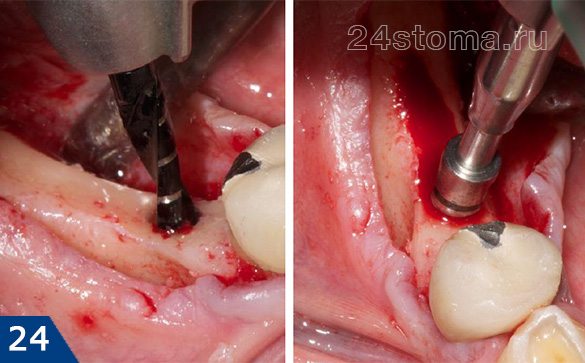 С поверхности нижней челюсти отслоена десна, сверлами формируется костное ложе под импланты