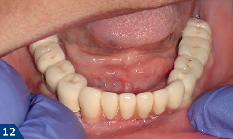 Вид трех мостовидных протезов на нижней челюсти (мост в области передних зубов также изготовлен с наличием искусственной десны)