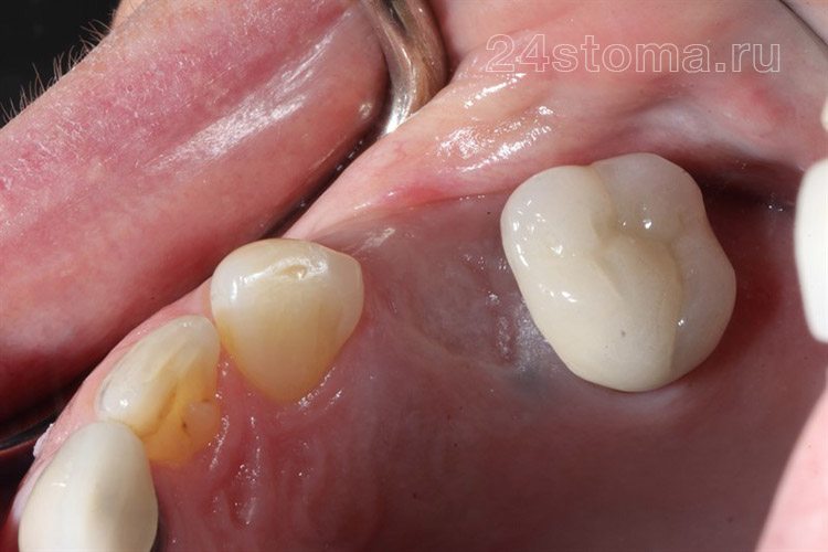 Исходная ситуация: дефект зубного ряда верхней челюсти