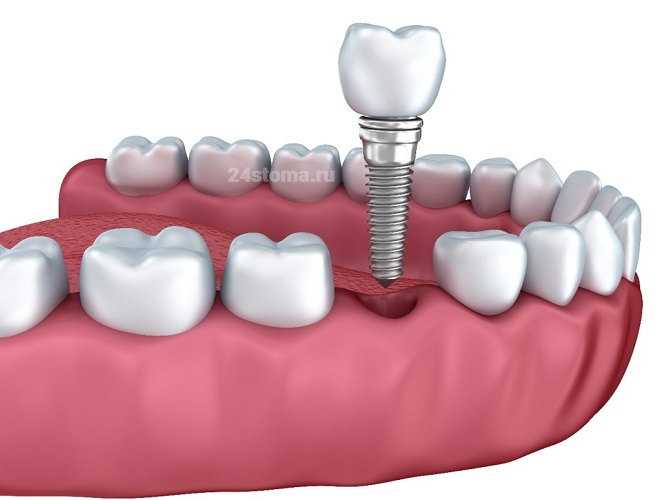 Схема установки зубного имплантата