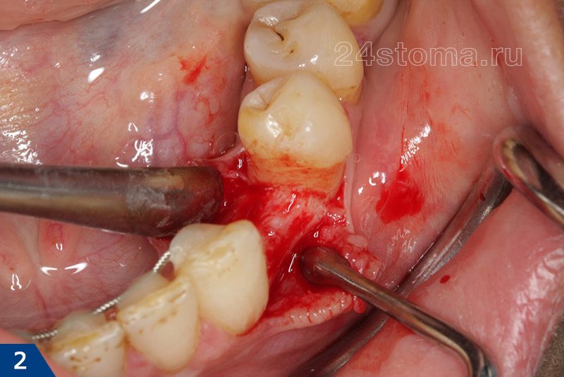 В области отсутствующего зуба отслоен слизисто-надкостничный лоскут, обнажена кость