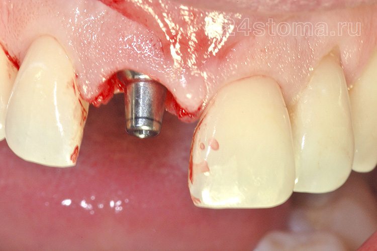 В имплант вставлен абатмент для немедленного временного востановления зуба искусственной коронкой