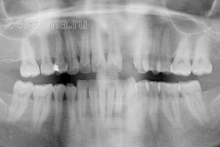 Рентгенограмма челюсти перед имплантацией