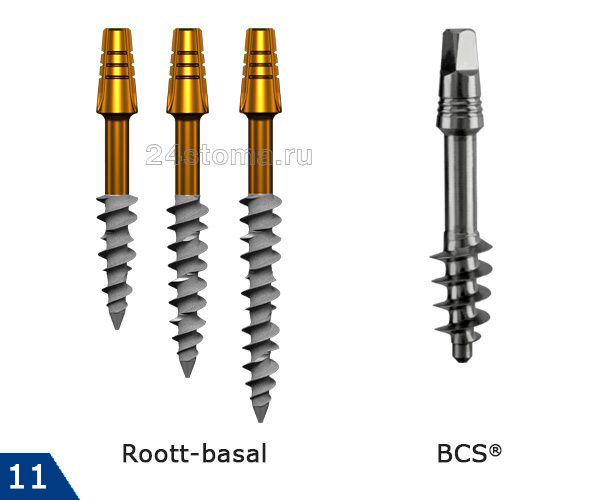 Базальные импланты «Trate AG» (Roott-basal) и «Ihde Dental AG» (BCS®)