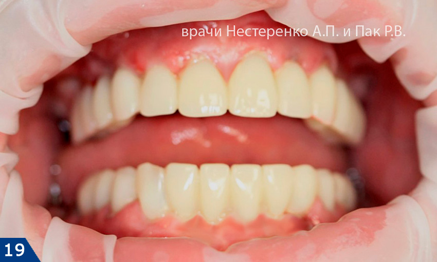 Базальная имплантация зубов на нижней челюсти. Фото предоставлено Московским центром имплантации ROOTT.
