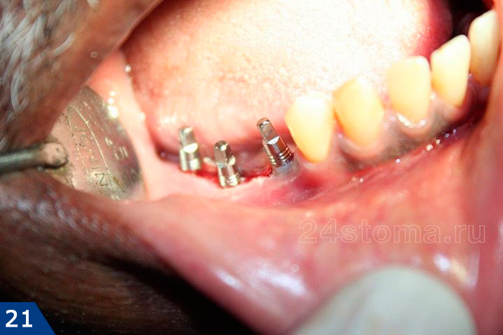 Установлено 3 базальных импланта компании Ihde Dental (Швейцария)