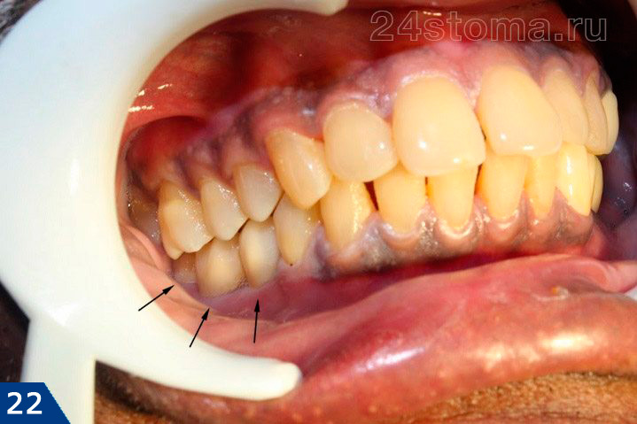 Вид готовой работы: на базальные импланты фиксирован металлокерамический мостовидный протез (восстановлены 5-6-7 зубы)