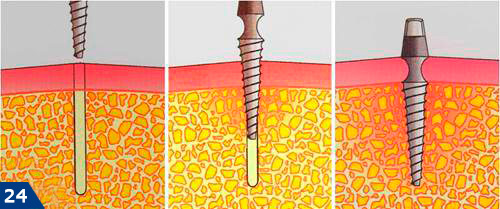 Процесс установки базального импланта