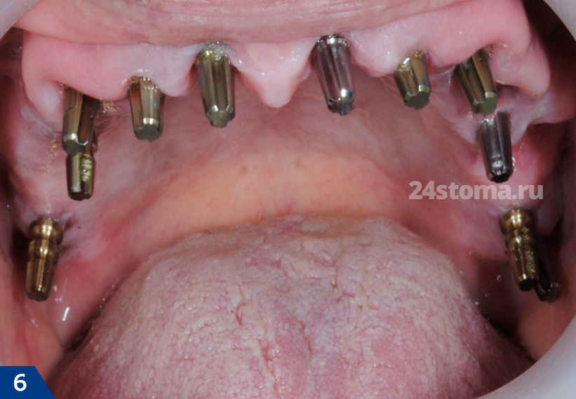 Базальная имплантация зубов (хирургический этап)