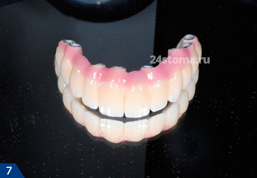 Базальная имплантация зубов (этап постоянного протезирования)