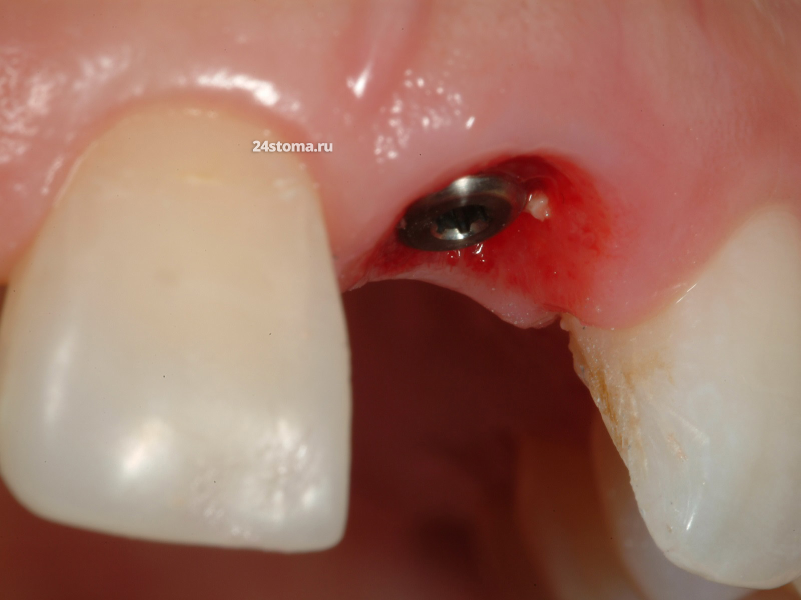 Протезирование переднего зуба циркониевой коронкой на зубном имплантате