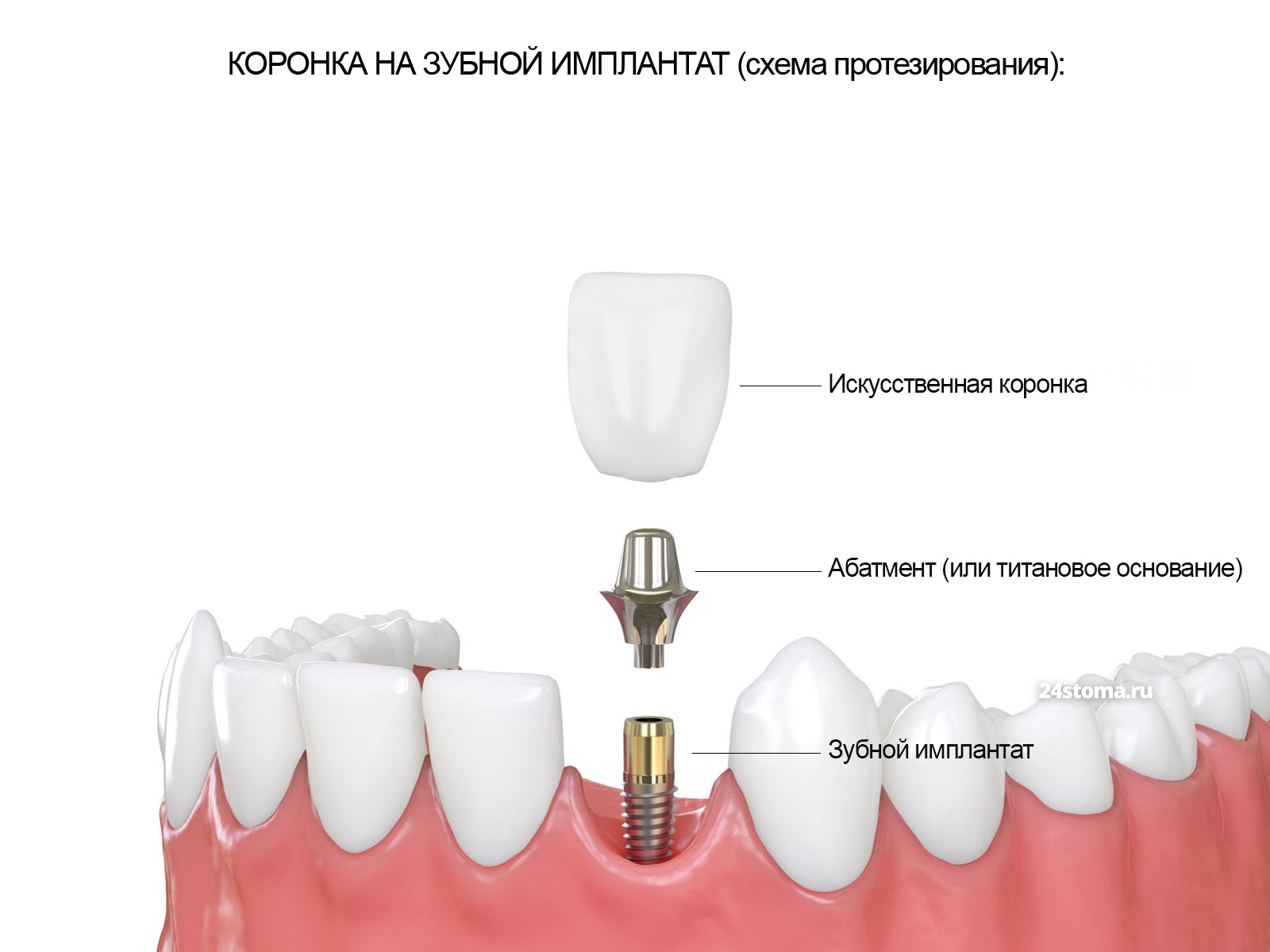 Коронка на зубной имплантат.