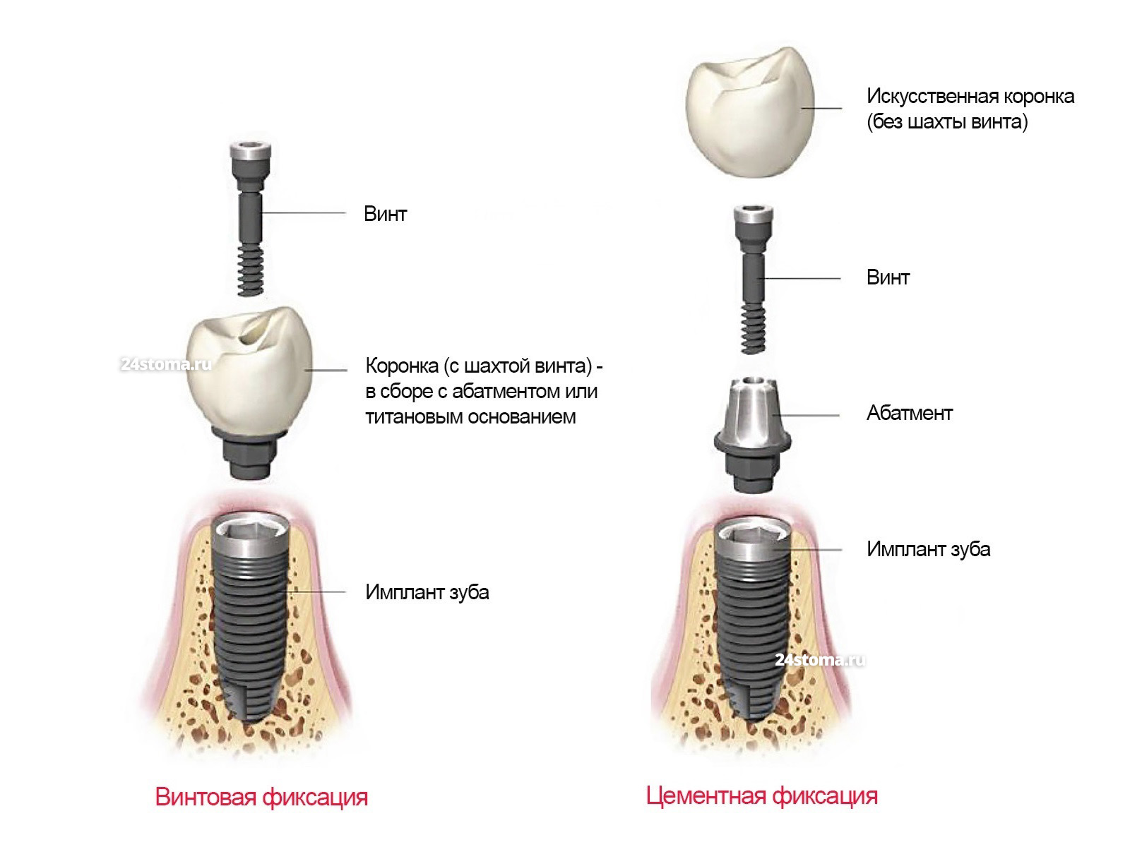 Винтовая фиксация/ цементная фиксация коронки к импланту зуба.