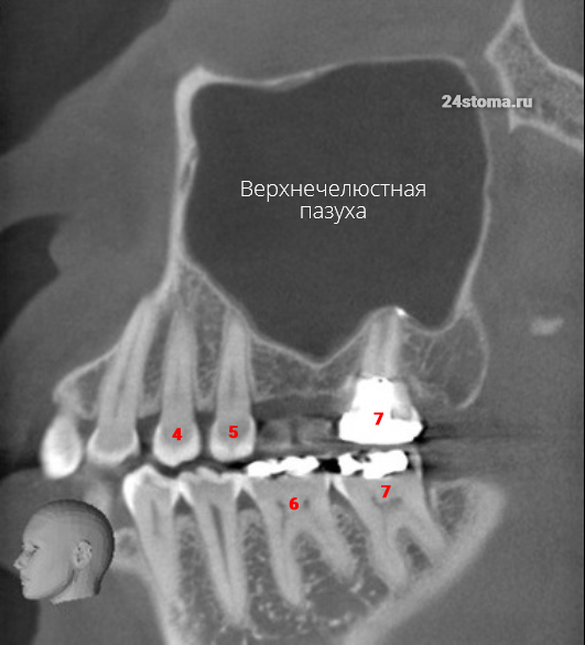 Обратите внимание на опущение дна верхнечелюстной пазухи - в области отсутствующего 6 зуба