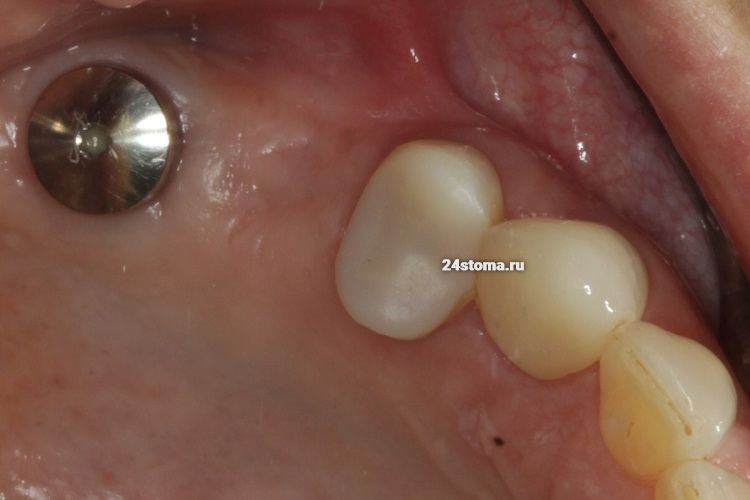 Исходная ситуация - планируется закрытый синус-лифтинг в области отсутствующего верхнего 5 зуба