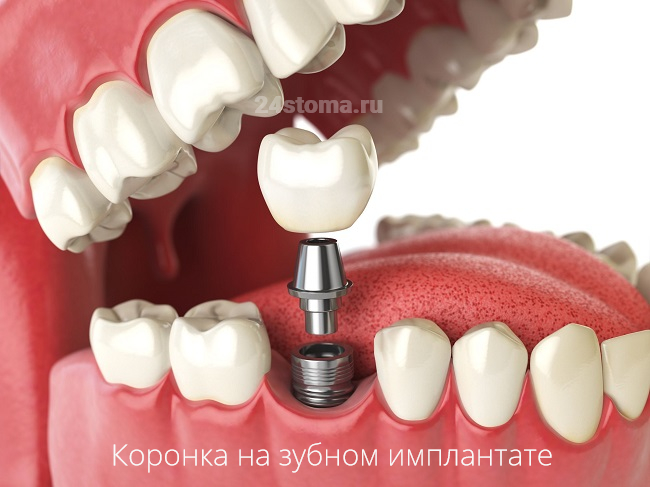 Схема протезирования коронкой на импланте (в зубной имплантат снача вкручивается абатмент, на который уже в свою очередь фиксируется коронка)