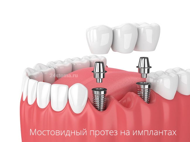 Протезирование мостовидным протезом на зубных имплантах (в импланты сначала вставляются абатменты, на которые уже и фиксируется мостовидный протез)