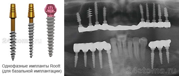 Варианты однофазных имплантов Roott (имеют несъемные абатменты), и их вид на рентгеновском снимке.