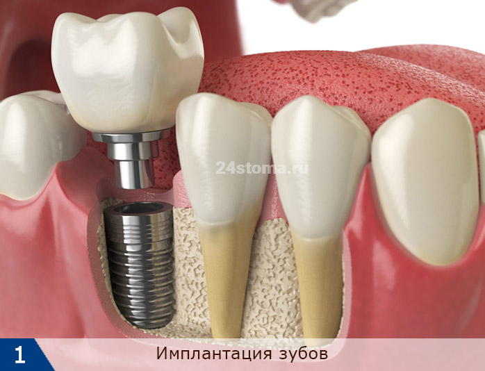 Имплантация зубов в стоматологии (схема)