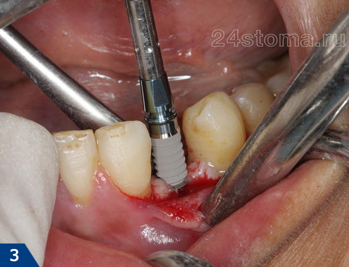 Процесс установки импланта Nobel Biocare в костную ткань челюсти
