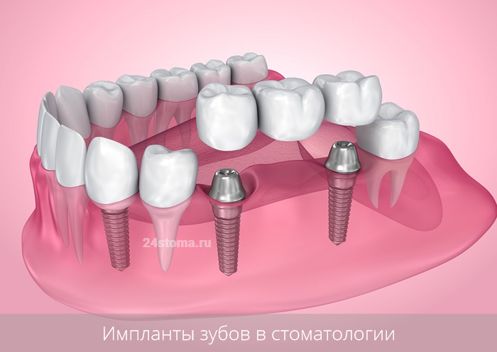Импланты зубов в стоматологии (схема протезирования мостовидным протезом на имплантах)