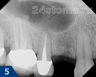 Исходная ситуация: необходимо установить имплант на месте отсутствующего премоляра (24 зуб)